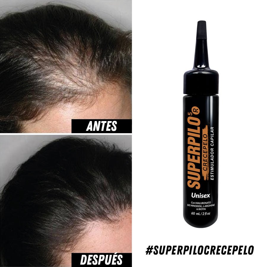 Entradas del cabello antes y después, junto al frasco del tónico – Superpilo tónico crecepelo | Nova Oficial