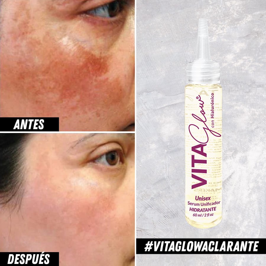 Mancha en el rostro antes y después, junto al frasco del sérum – VitaGlow sérum aclarante | Nova Oficial